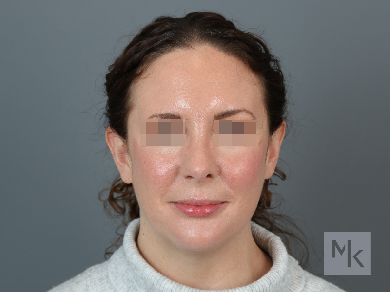 Rhinoplasty Before and After | Dr. Michael Kim