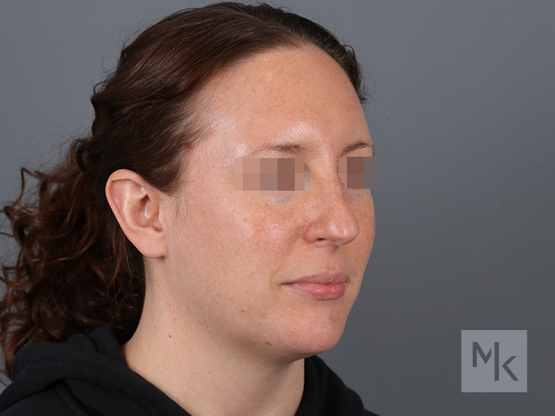 Rhinoplasty Before and After | Dr. Michael Kim