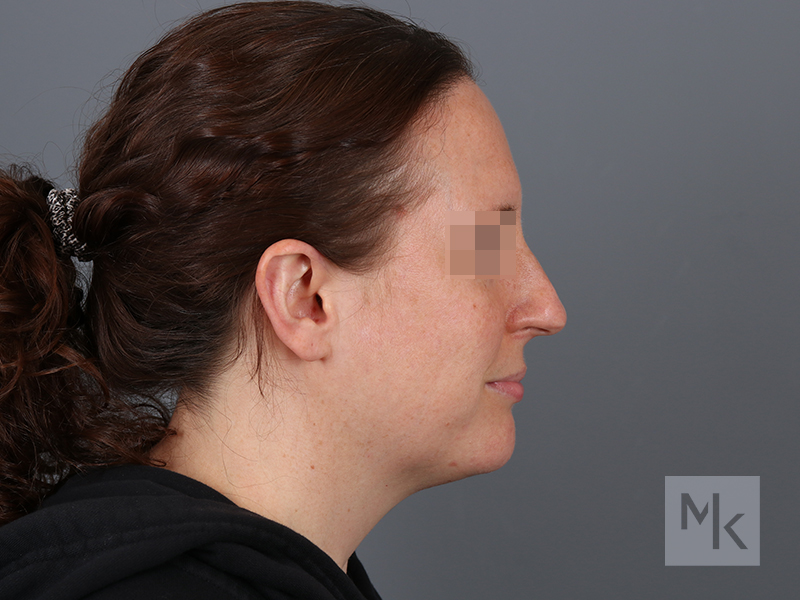 Rhinoplasty Before and After | Dr. Michael Kim