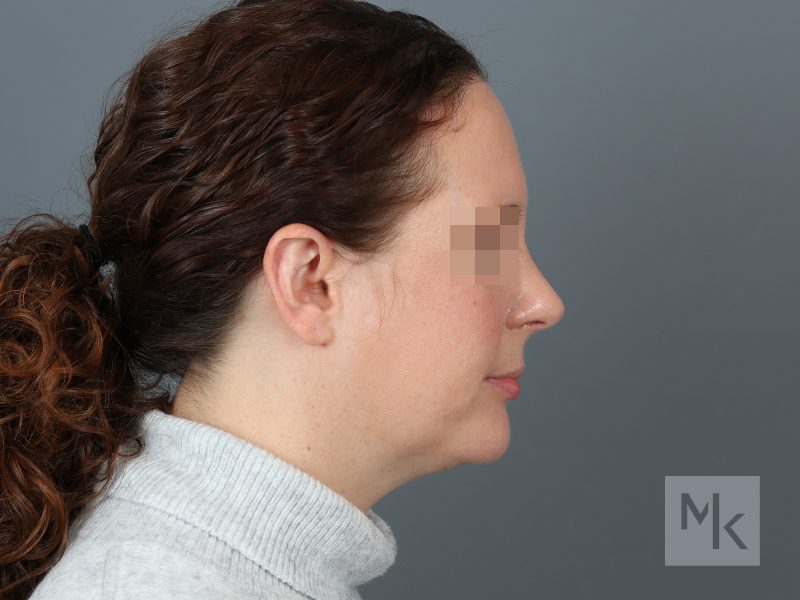 Rhinoplasty Before and After | Dr. Michael Kim