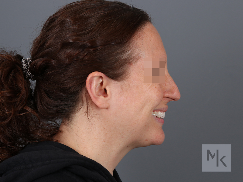 Rhinoplasty Before and After | Dr. Michael Kim