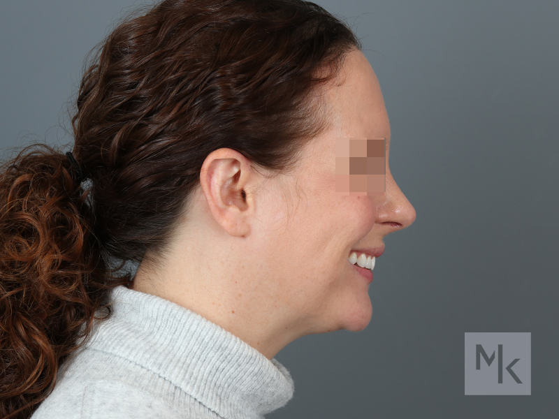 Rhinoplasty Before and After | Dr. Michael Kim