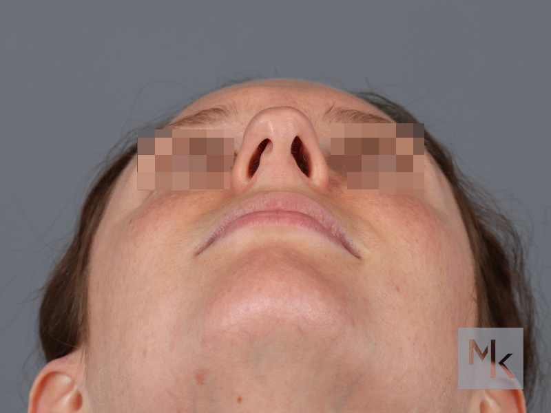 Rhinoplasty Before and After | Dr. Michael Kim