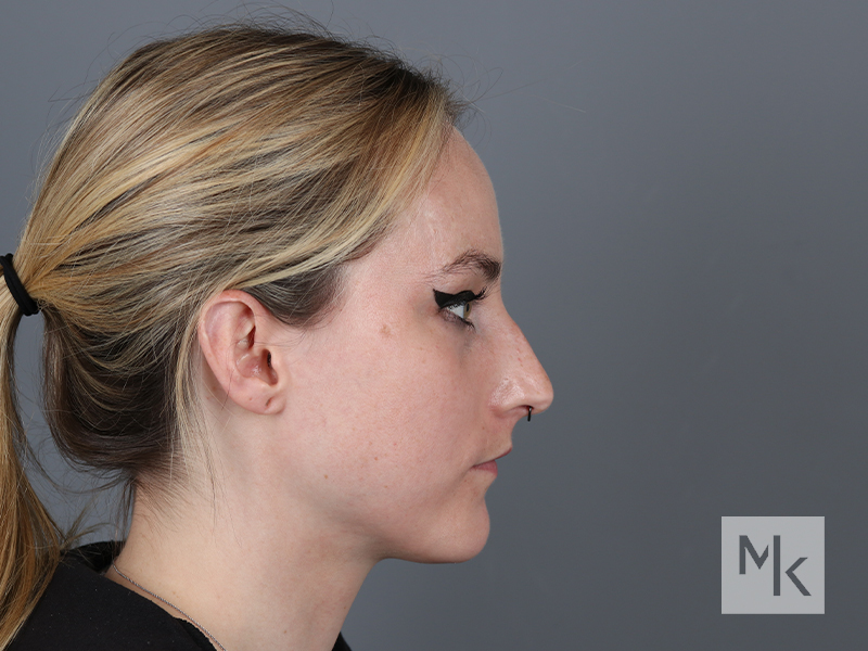 Rhinoplasty Before and After | Dr. Michael Kim