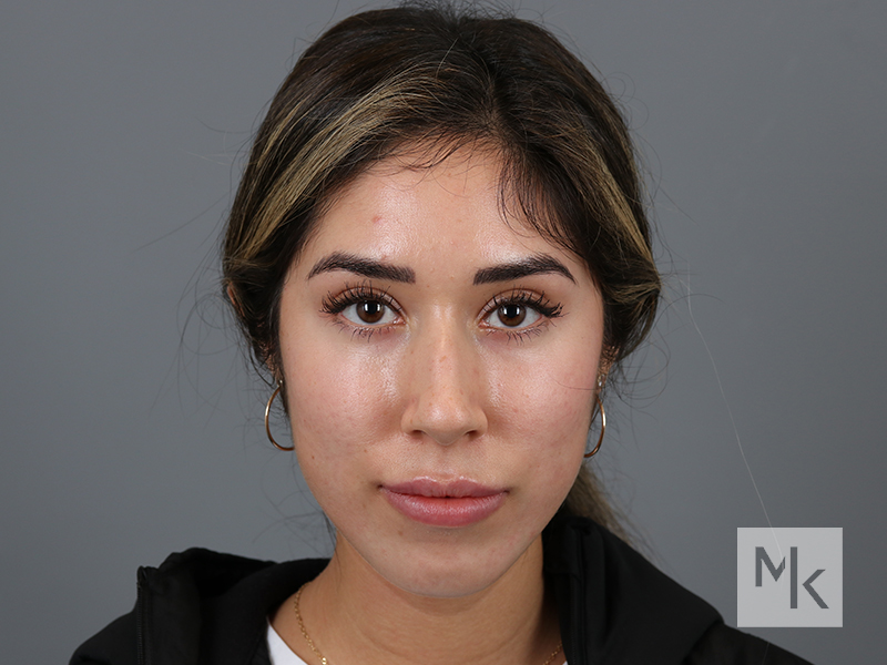 Rhinoplasty Before and After | Dr. Michael Kim