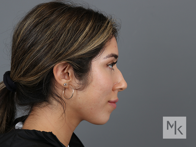 Rhinoplasty Before and After | Dr. Michael Kim