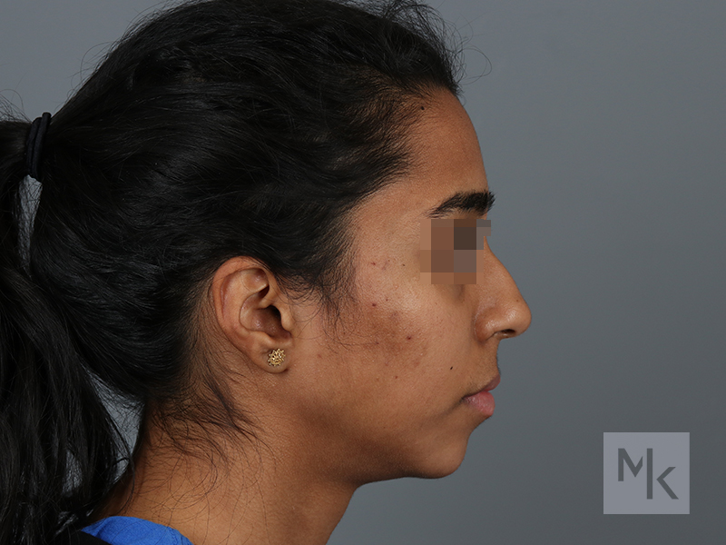 Rhinoplasty Before and After | Dr. Michael Kim