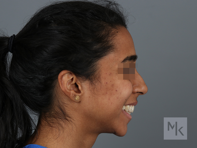 Rhinoplasty Before and After | Dr. Michael Kim