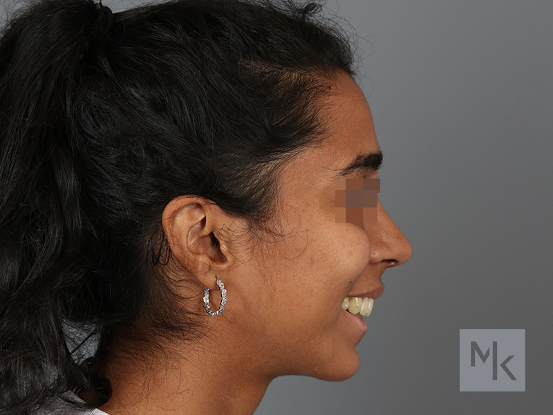 Rhinoplasty Before and After | Dr. Michael Kim