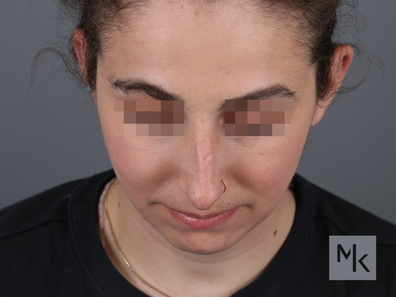 Rhinoplasty Before and After | Dr. Michael Kim