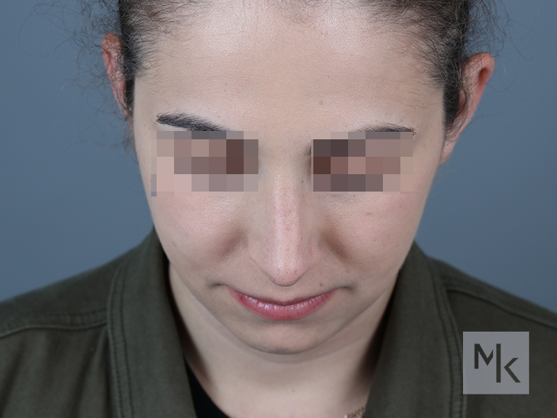 Rhinoplasty Before and After | Dr. Michael Kim