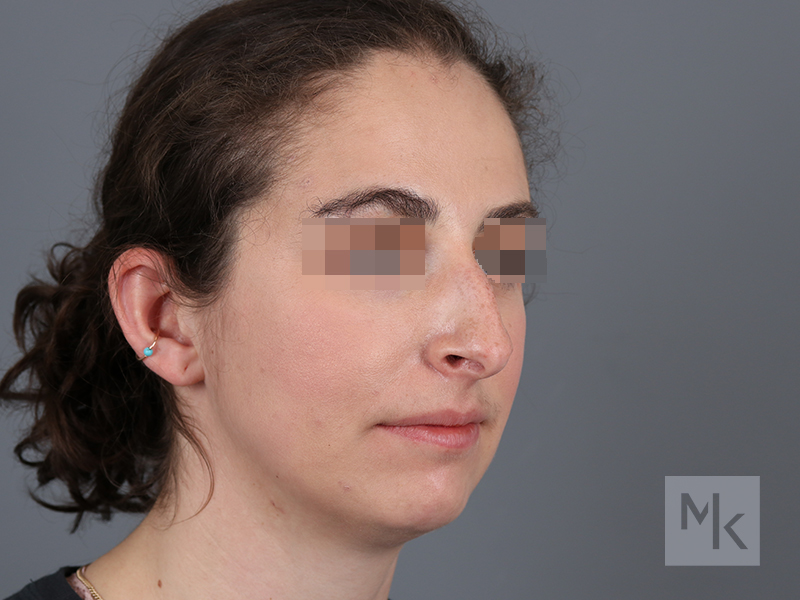 Rhinoplasty Before and After | Dr. Michael Kim