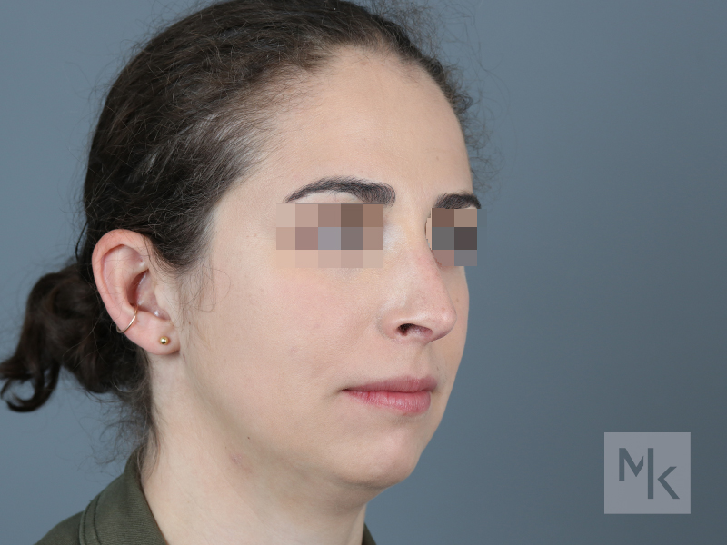 Rhinoplasty Before and After | Dr. Michael Kim