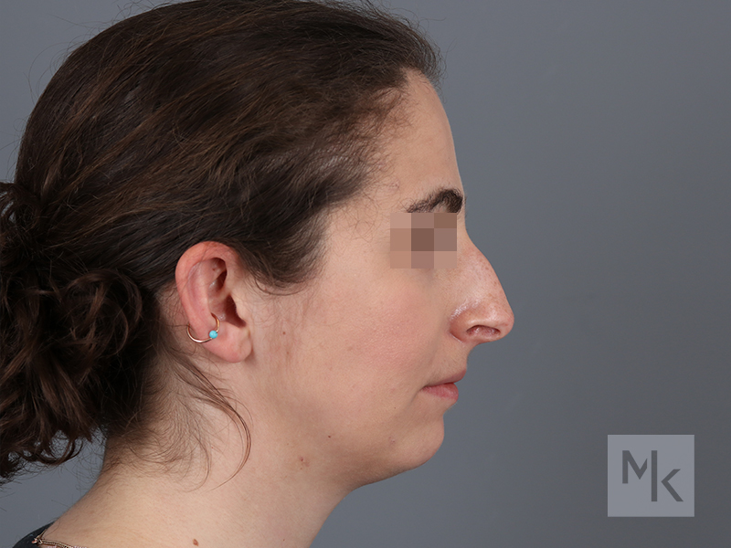 Rhinoplasty Before and After | Dr. Michael Kim