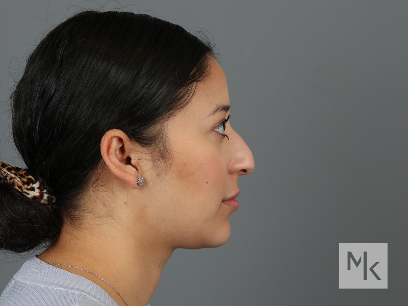 Rhinoplasty Before and After | Dr. Michael Kim