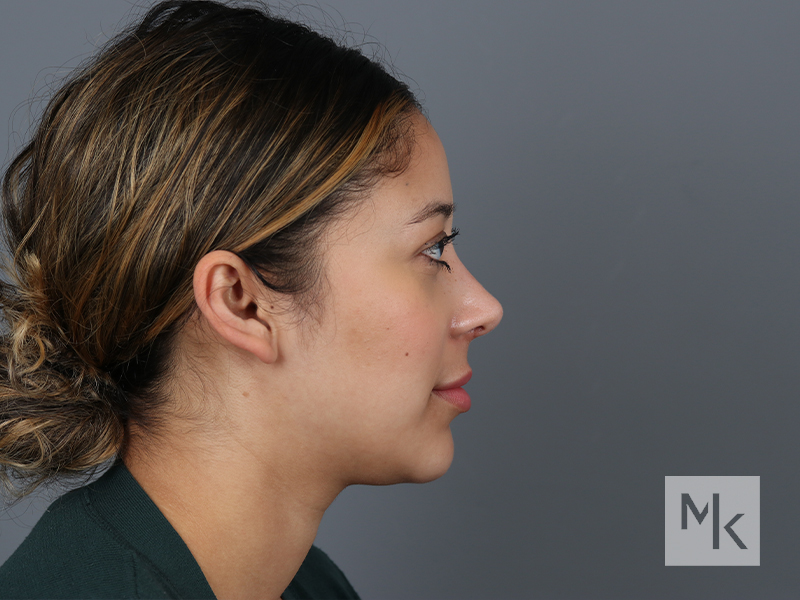 Rhinoplasty Before and After | Dr. Michael Kim