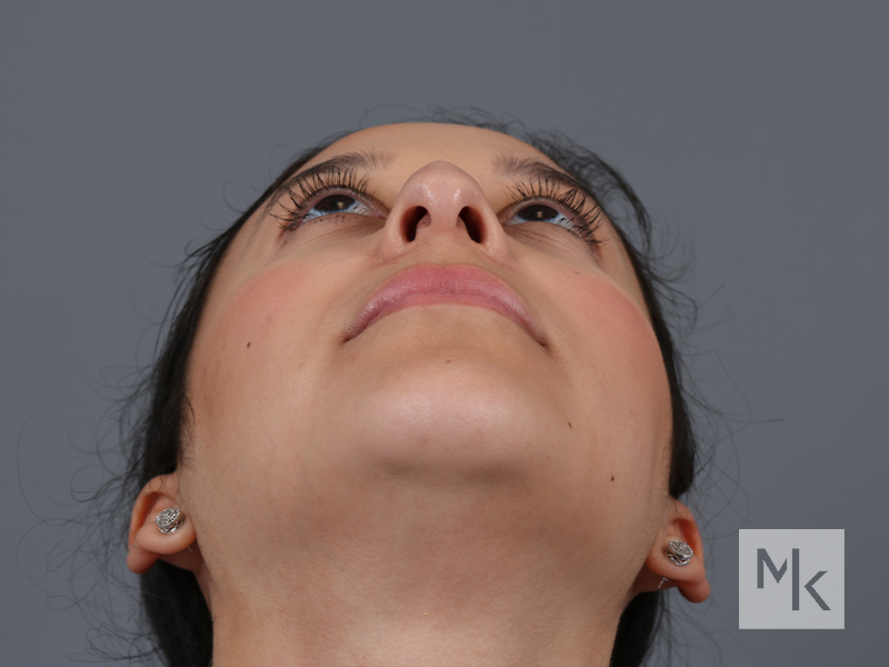 Rhinoplasty Before and After | Dr. Michael Kim