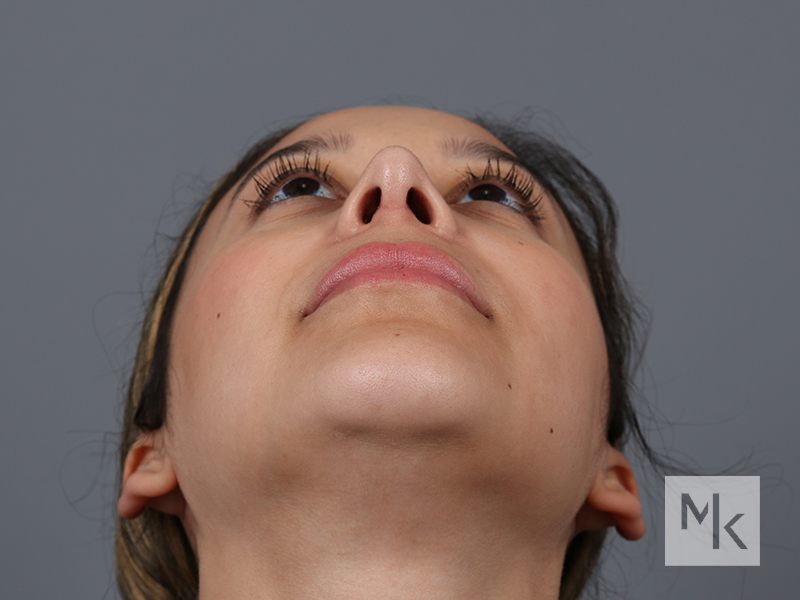 Rhinoplasty Before and After | Dr. Michael Kim