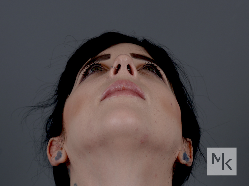 Rhinoplasty Before and After | Dr. Michael Kim