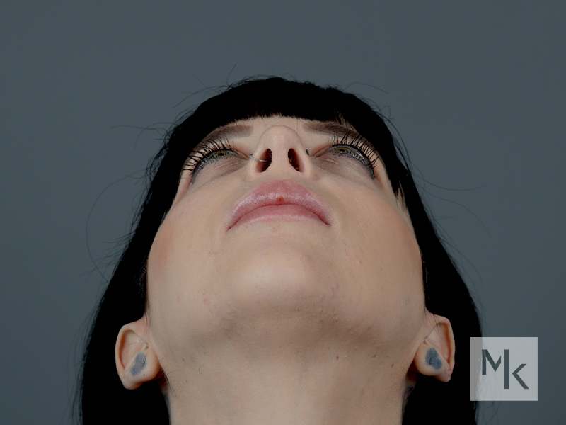 Rhinoplasty Before and After | Dr. Michael Kim
