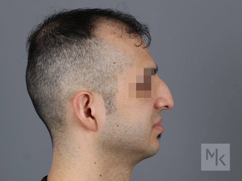 Rhinoplasty Before and After | Dr. Michael Kim