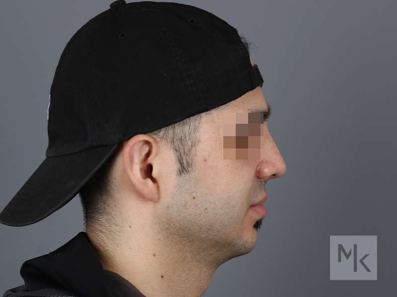 Rhinoplasty Before and After | Dr. Michael Kim