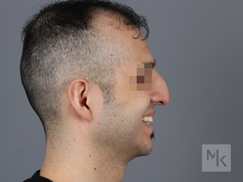 Rhinoplasty Before and After | Dr. Michael Kim