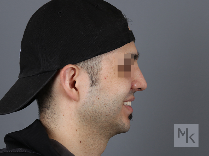 Rhinoplasty Before and After | Dr. Michael Kim