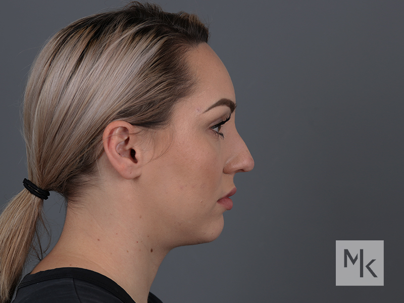 Rhinoplasty Before and After | Dr. Michael Kim