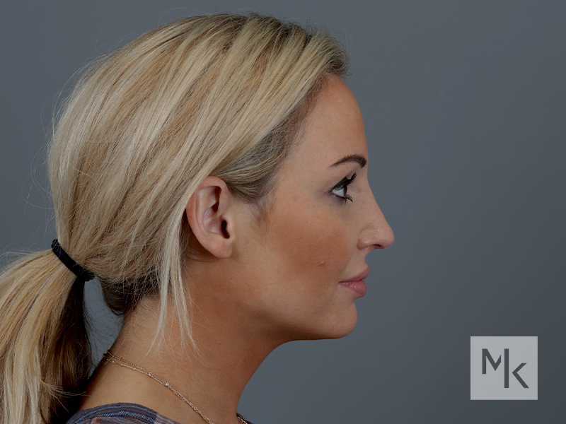 Rhinoplasty Before and After | Dr. Michael Kim