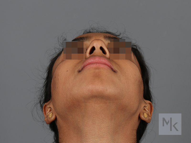 Rhinoplasty Before and After | Dr. Michael Kim