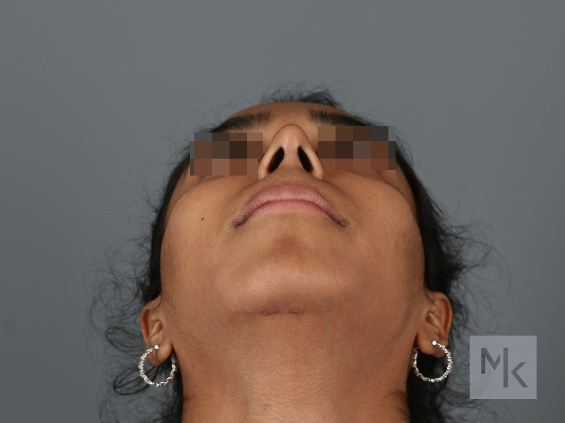 Rhinoplasty Before and After | Dr. Michael Kim