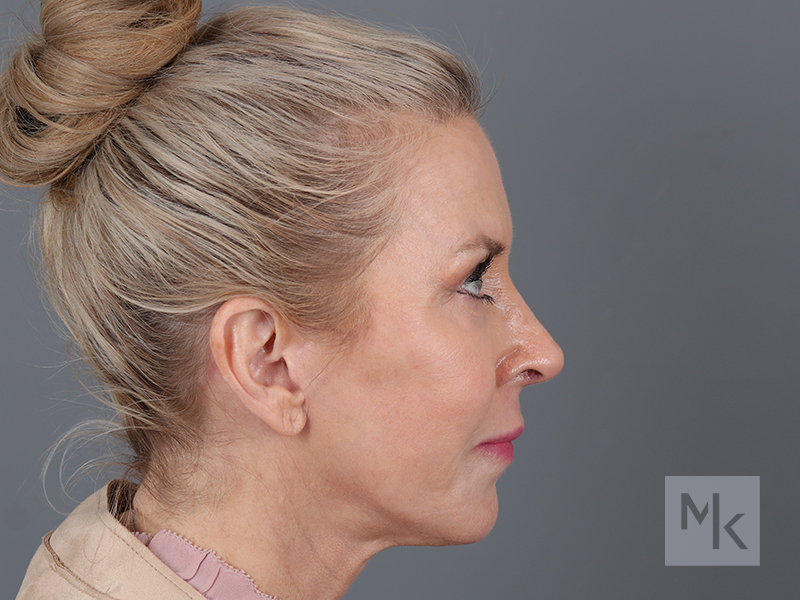 Rhinoplasty Before and After | Dr. Michael Kim