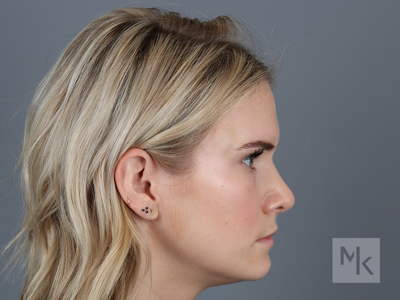 Rhinoplasty Before and After | Dr. Michael Kim