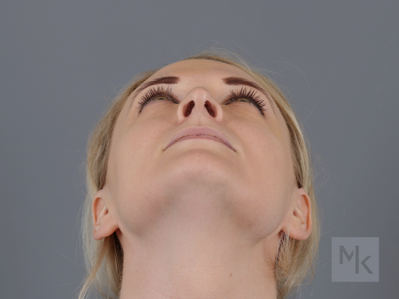 Rhinoplasty Before and After | Dr. Michael Kim