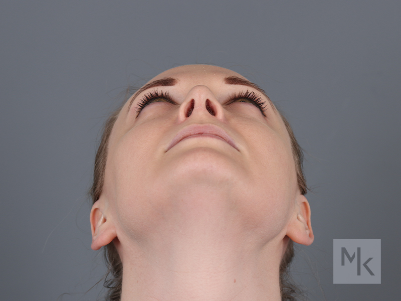 Rhinoplasty Before and After | Dr. Michael Kim