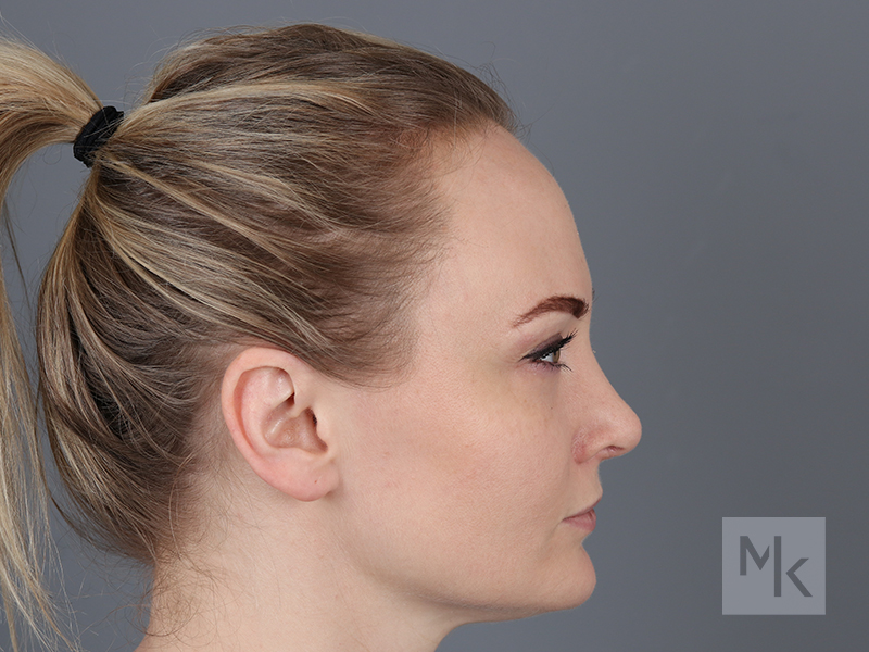 Rhinoplasty Before and After | Dr. Michael Kim