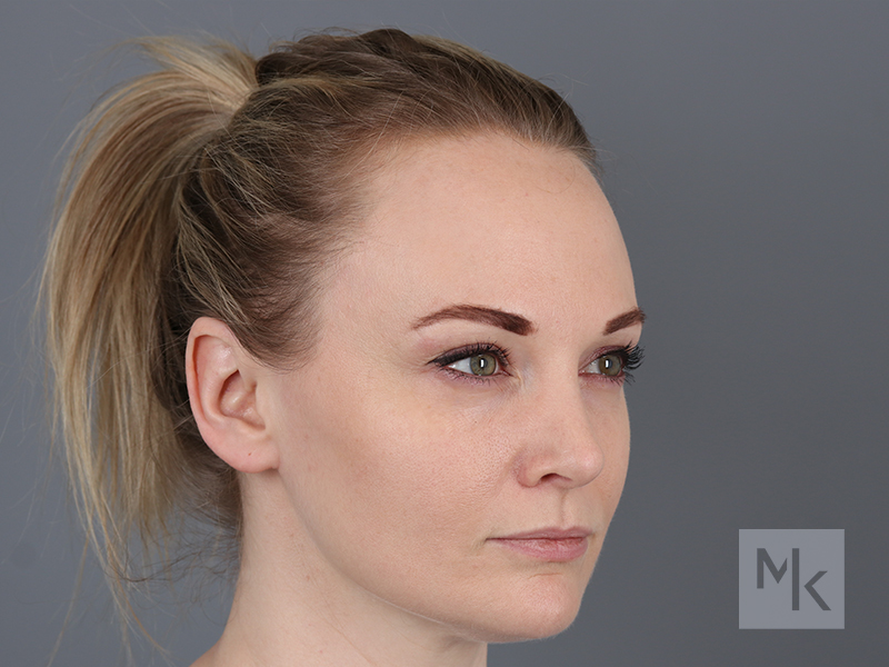Rhinoplasty Before and After | Dr. Michael Kim
