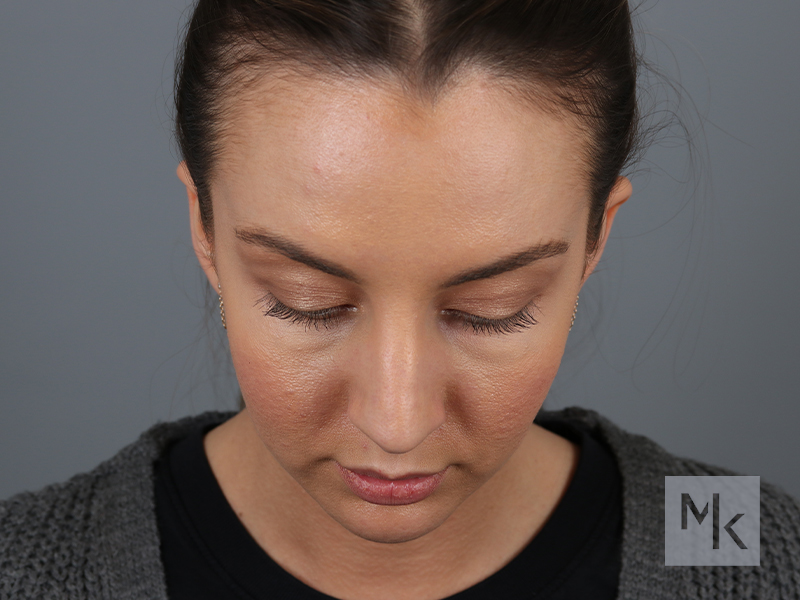 Rhinoplasty Before and After | Dr. Michael Kim