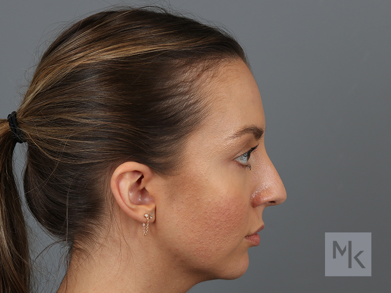 Rhinoplasty Before and After | Dr. Michael Kim