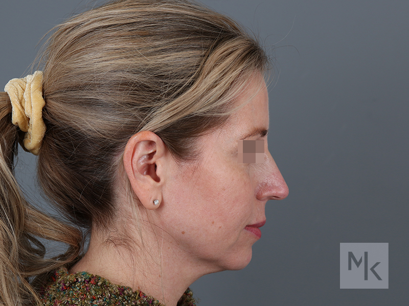 Rhinoplasty Before and After | Dr. Michael Kim