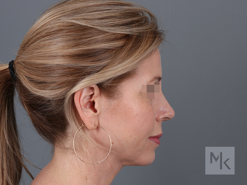 Rhinoplasty Before and After | Dr. Michael Kim