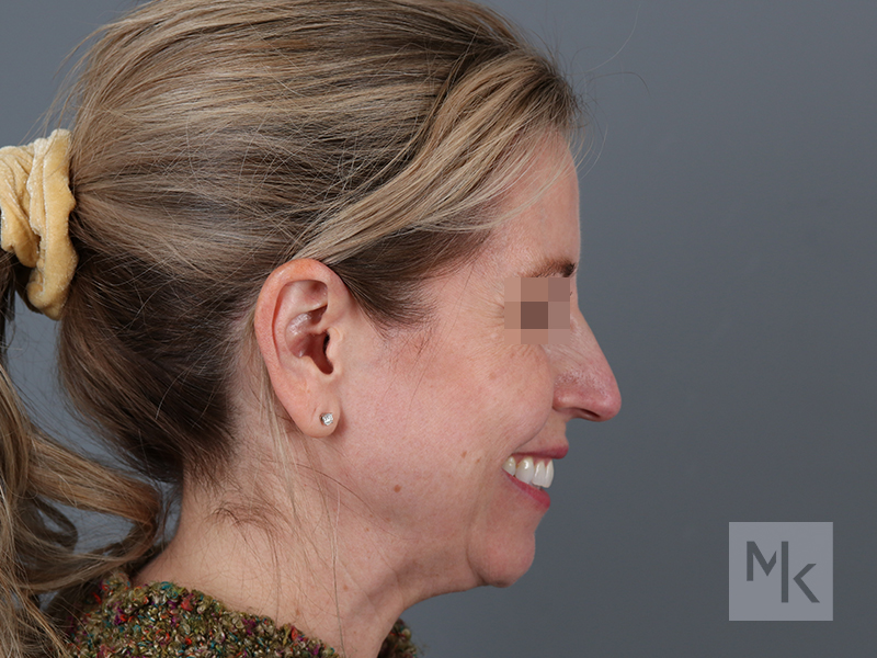 Rhinoplasty Before and After | Dr. Michael Kim