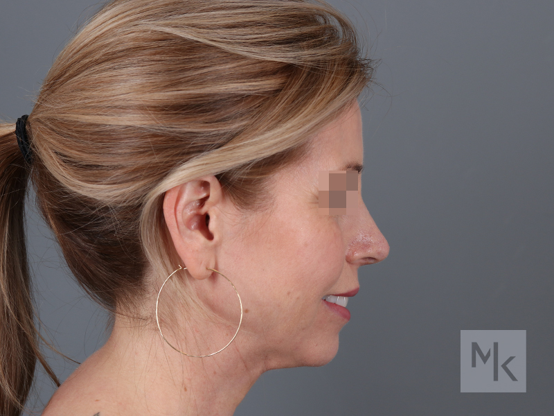 Rhinoplasty Before and After | Dr. Michael Kim