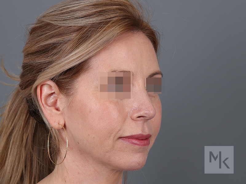 Rhinoplasty Before and After | Dr. Michael Kim