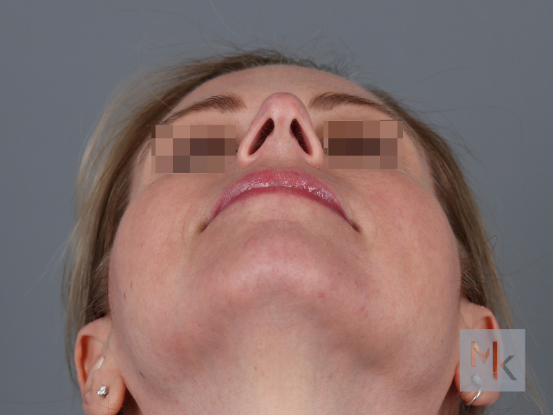 Rhinoplasty Before and After | Dr. Michael Kim