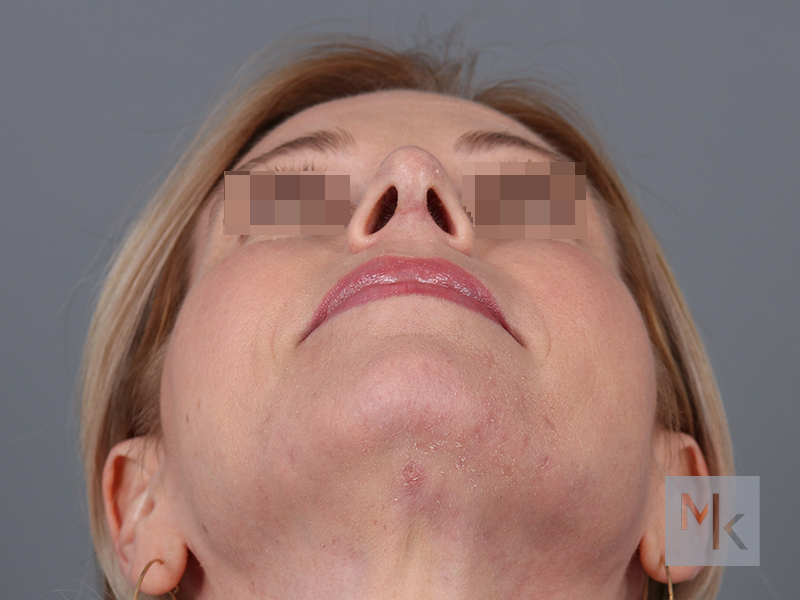 Rhinoplasty Before and After | Dr. Michael Kim