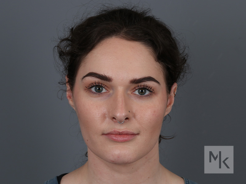 Rhinoplasty Before and After | Dr. Michael Kim