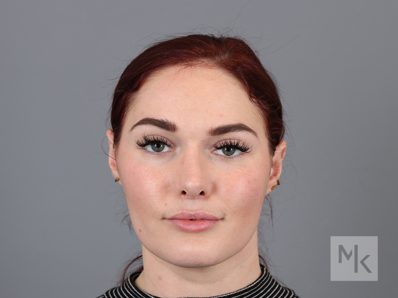 Rhinoplasty Before and After | Dr. Michael Kim