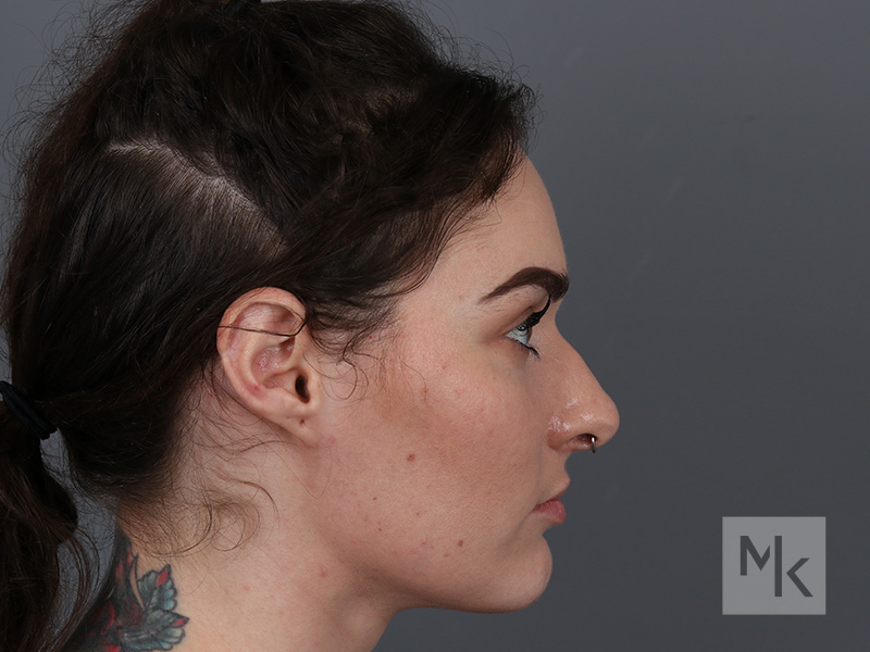 Rhinoplasty Before and After | Dr. Michael Kim